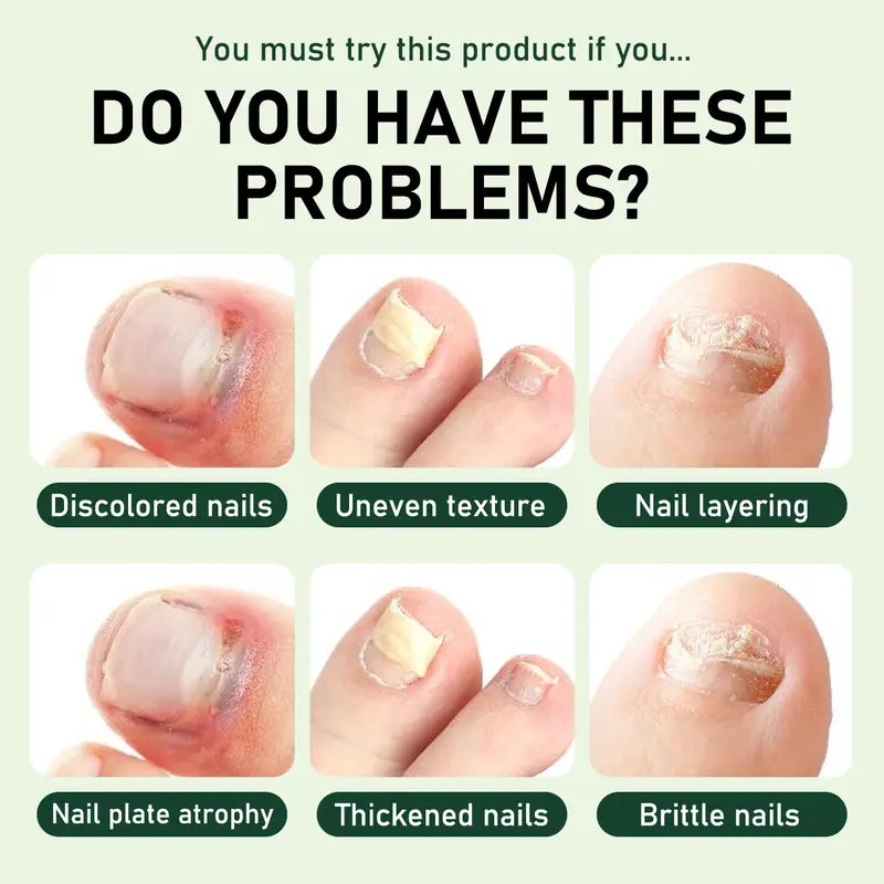 Umex®  7-Day Lightweight Nail Strengthening & Repair Serum