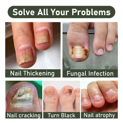 Umex®  7-Day Lightweight Nail Strengthening & Repair Serum